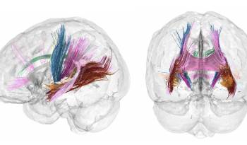 El volumen de materia gris cortical se reduce conforme avanza un embarazo. Los colores más oscuros indican las regiones que más reducen el volumen de materia gris durante la gestación.