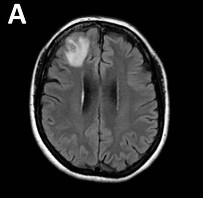 Un gusano redondo parásito que normalmente se encuentra en las serpientes ha sido extraído vivo y retorciéndose del cerebro de una mujer.