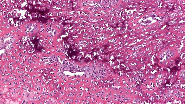 Microfotografía de un sarcoma óseo.