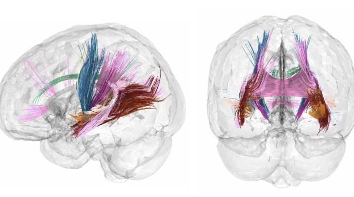 El volumen de materia gris cortical se reduce conforme avanza un embarazo. Los colores más oscuros indican las regiones que más reducen el volumen de materia gris durante la gestación.